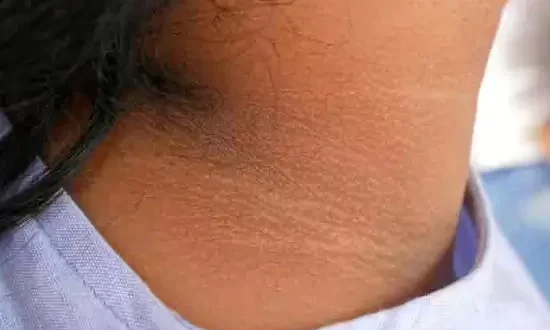 أسباب اسمرار الجسم: الأسباب المحتملة والعلاجات الفعالة