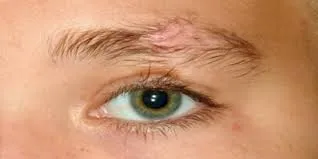 10 أسباب تساقط الحواجب وطرق العلاج الفعالة