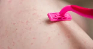 كيفية تجنب أسباب ظهور الحبوب بعد إزالة الشعر