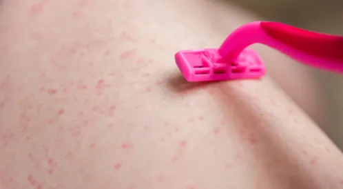 كيفية تجنب أسباب ظهور الحبوب بعد إزالة الشعر